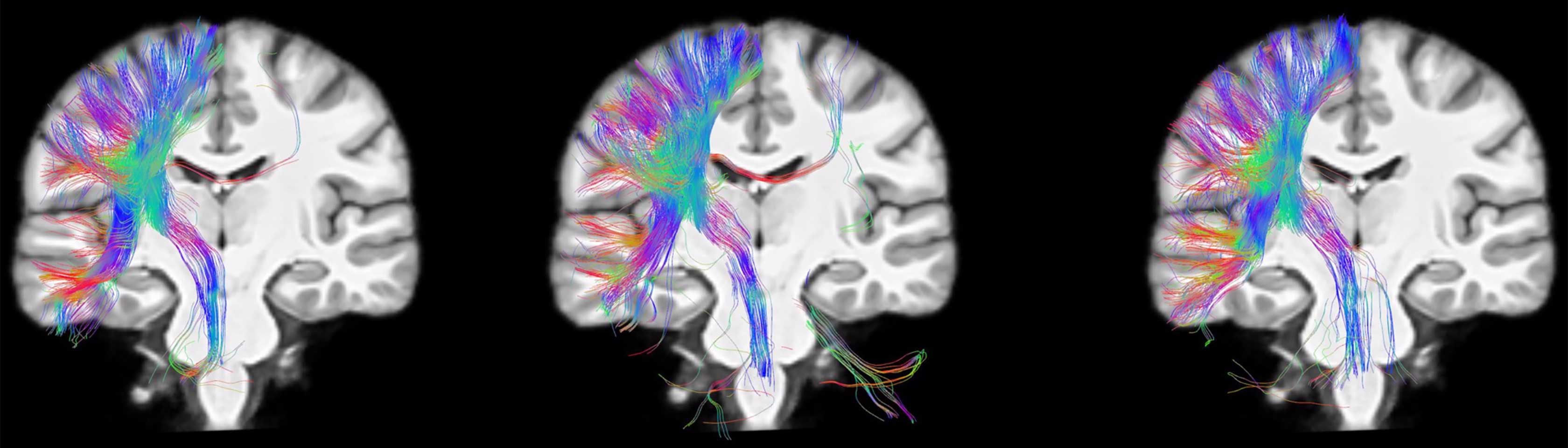 Brain Triplicate